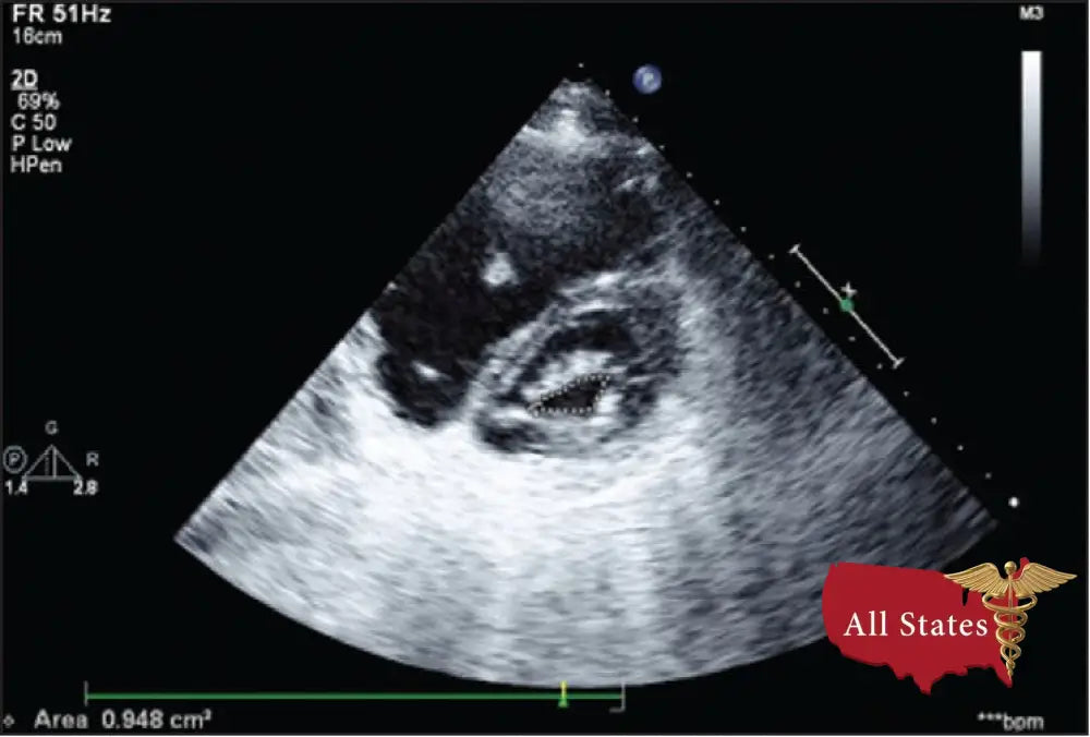 GE Vivid E9 XDClear Refurbished with 3 Probes