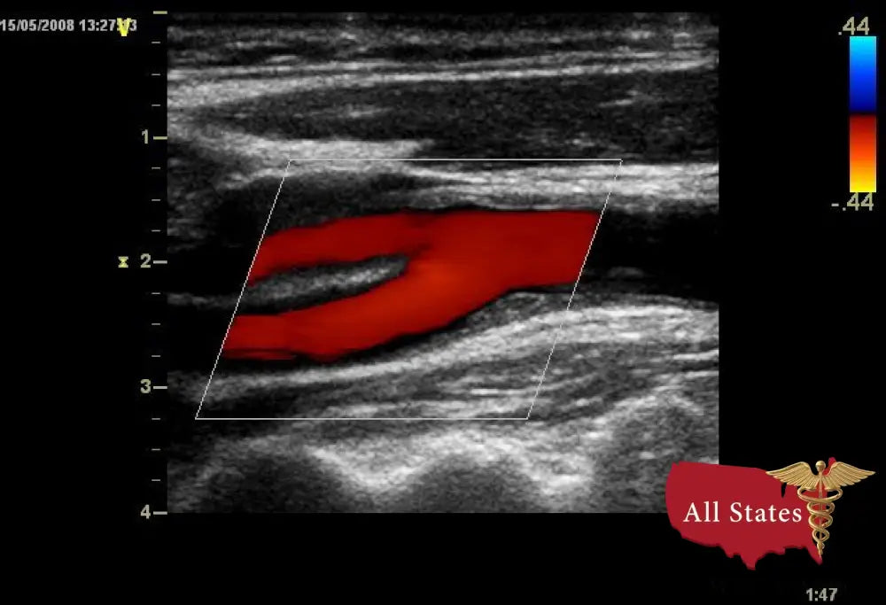 GE Vivid E9 XDClear Refurbished with 3 Probes