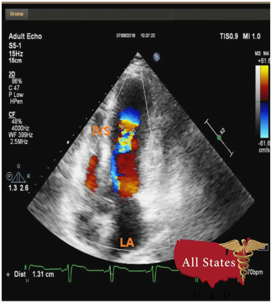 GE Vivid E9 XDClear Refurbished with 3 Probes