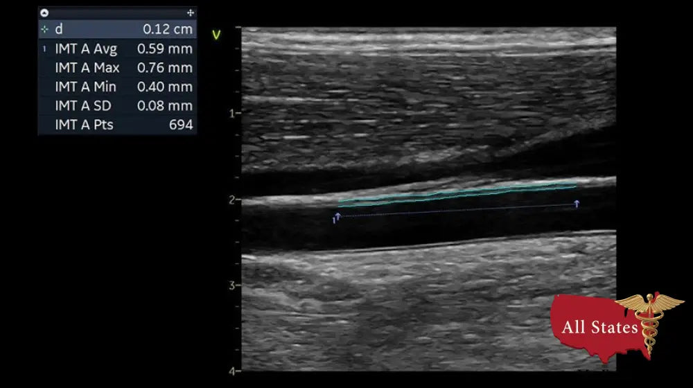 GE Vivid IQ Ultra Edition Portable Ultrasound