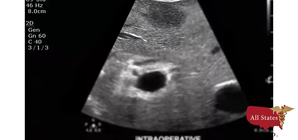 Philips CX50 Refurbished with 3 Probes