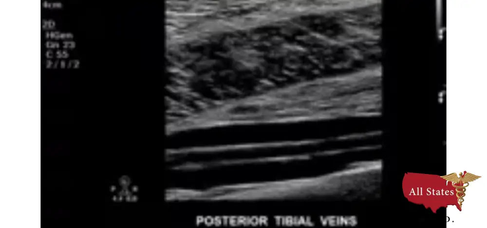 Philips CX50 Refurbished with 3 Probes