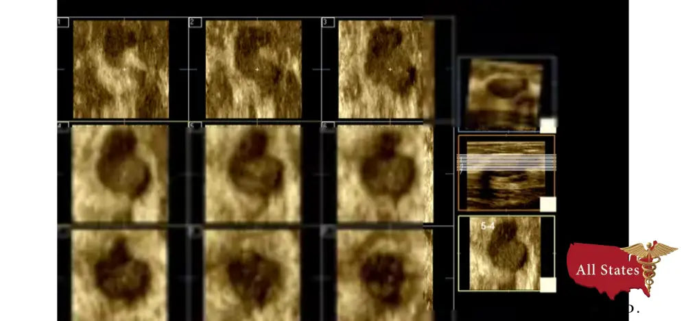 Philips CX50 Refurbished with 3 Probes