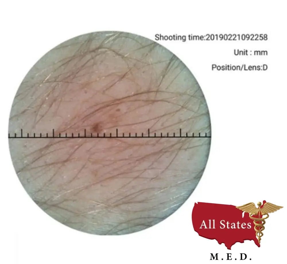 Riester 13270 Dermatoscope Lens for RCS-100 Camera Unit